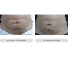 Body Contouring Melbourne - anti-aging Cosmetic & Laser