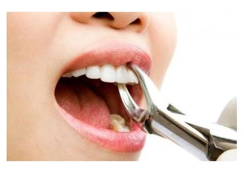 Affordable Tooth Extraction in Burnside - Parkwood Green Dental