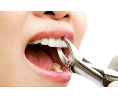 Affordable Tooth Extraction in Burnside - Parkwood Green Dental