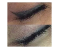 Eyeliner Tattoo Removal Melbourne - Doff&Flux Tattoo Removal Melbourne