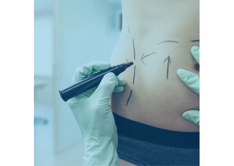 Top Tummy Tuck Surgeon In Sydney