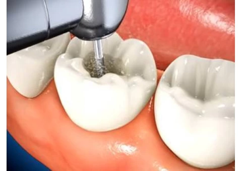 Best Root Canal Treatment in Burnside - Parkwood Green Dental