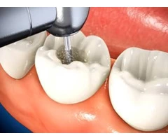 Best Root Canal Treatment in Burnside - Parkwood Green Dental