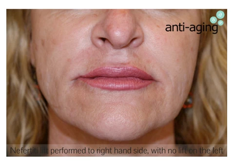 Skin Tightening Melbourne - anti-aging Cosmetic & Laser - 2/2