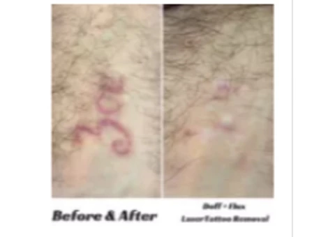 Laser Hair Removal Melbourne - Doff&Flux Tattoo Removal Melbourne