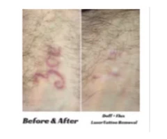 Laser Hair Removal Melbourne - Doff&Flux Tattoo Removal Melbourne