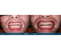 Everything You Need to Know About Porcelain Dental Veneers Services