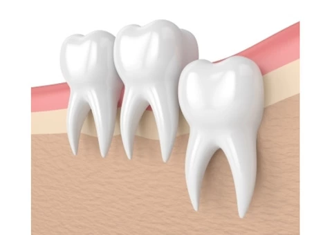 Everything You Need to Know About Porcelain Dental Veneers Services - 3/3