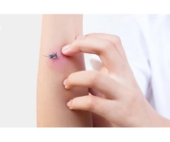 Bothered About Mosquito Bites? Follow These Tips for Quick Relief