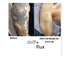 Laser Tattoo Removal in Melbourne | Doff and Flux
