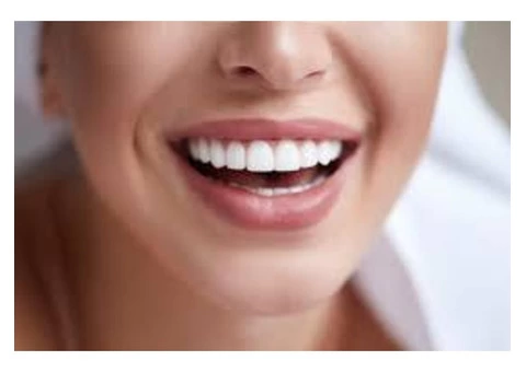 Affordable Cost for Composite Veneers in Melbourne