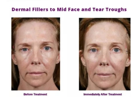 Dermal Fillers in Toorak - Timeless Anti Ageing Clinic - 1/3
