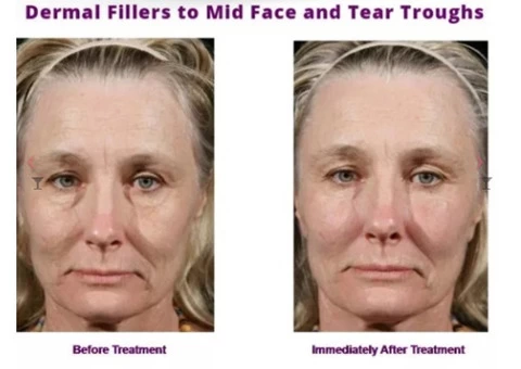 Dermal Fillers in Toorak - Timeless Anti Ageing Clinic - 2/3