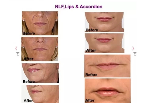 Dermal Fillers in Toorak - Timeless Anti Ageing Clinic - 3/3