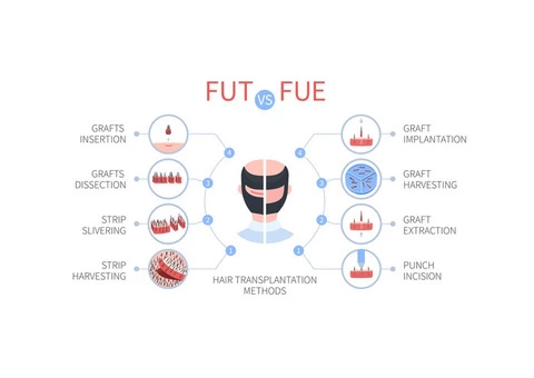 Fue vs fut treatment