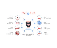 Fue vs fut treatment