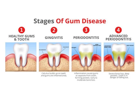 Get a Best Gum Disease Treatment For Batter Health