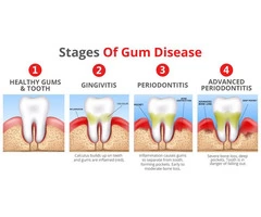 Get a Best Gum Disease Treatment For Batter Health