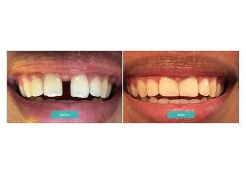 Get a Best Gum Disease Treatment For Batter Health - 2/2