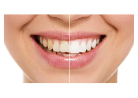 Teeth Whitening Brisbane