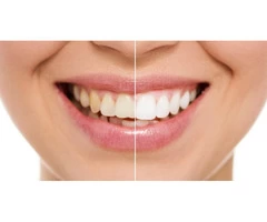 Teeth Whitening Brisbane