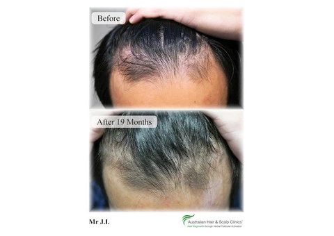 Take Control of your Hair’s Heath With Hair Loss Clinic in Malvern