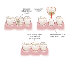 Crowns Services Arana Hills | Admire Dentistry