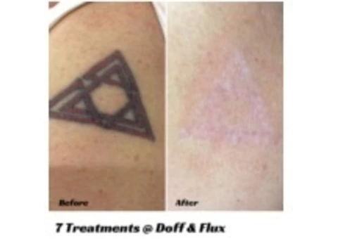 Tattoo Removal - A counsel how to remove your tattoo ink | Doff & Flux - 1/3