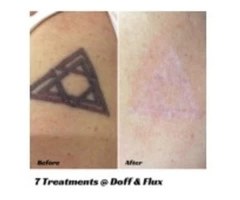 Tattoo Removal - A counsel how to remove your tattoo ink | Doff & Flux
