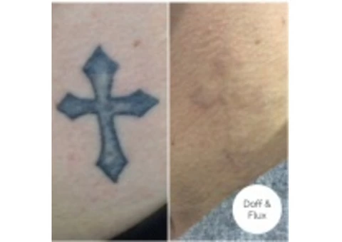 Tattoo Removal - A counsel how to remove your tattoo ink | Doff & Flux - 2/3