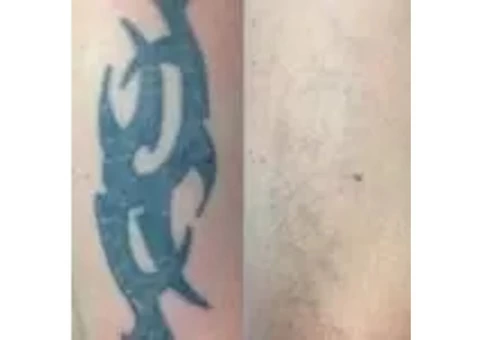 Tattoo Removal - A counsel how to remove your tattoo ink | Doff & Flux - 3/3