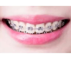 Invisalign Free Consultation at Australia