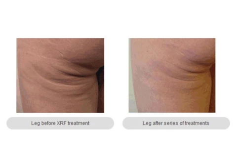 Skin Tightening Melbourne- anti-aging Cosmetic & Laser