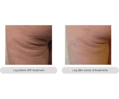 Skin Tightening Melbourne- anti-aging Cosmetic & Laser