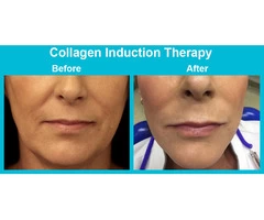 Skin Needling Brisbane – With Dermastamp Technology