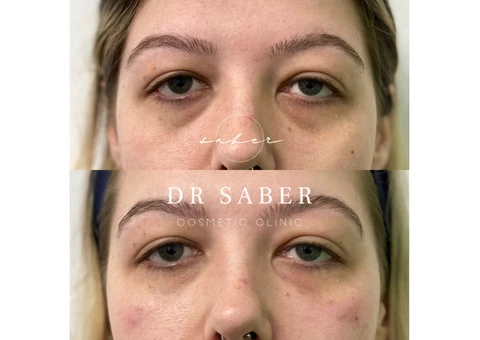 Wrinkle Relaxers | Anti Wrinkle Injections Werribee | Dr Saber - 1/3