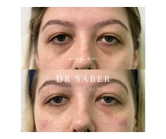 Wrinkle Relaxers | Anti Wrinkle Injections Werribee | Dr Saber