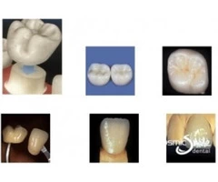 Dental Crowns in Sydney