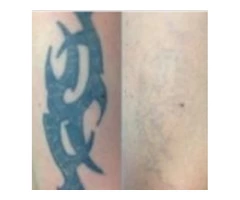 Laser Tattoo Removal in Melbourne | Doff and Flux