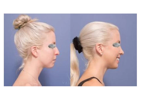 Rhinoplasty