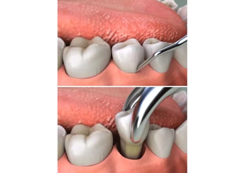 Get Dental Cleaning Near Me