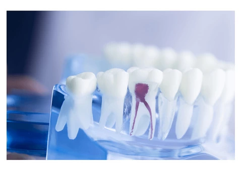 Root Canal Treatment in Melbourne Using Modern Technology - 1/3