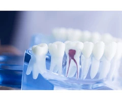 Root Canal Treatment in Melbourne Using Modern Technology