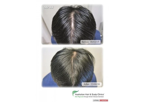 Opt for our hair loss treatment in Canberra today