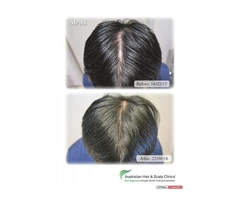 Opt for our hair loss treatment in Canberra today