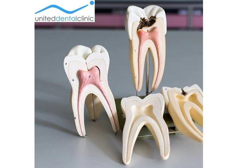 Root Canal Treatment: Purpose & Benefits | United Dental Clinic