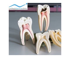 Root Canal Treatment: Purpose & Benefits | United Dental Clinic