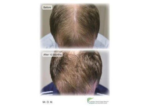 Go for hair treatment in Gold Coast and cure it permanently