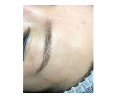 Best Revlite Laser Treatment Near Me