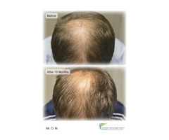 Now Avail Affordable Hair Loss Treatment in Adelaide